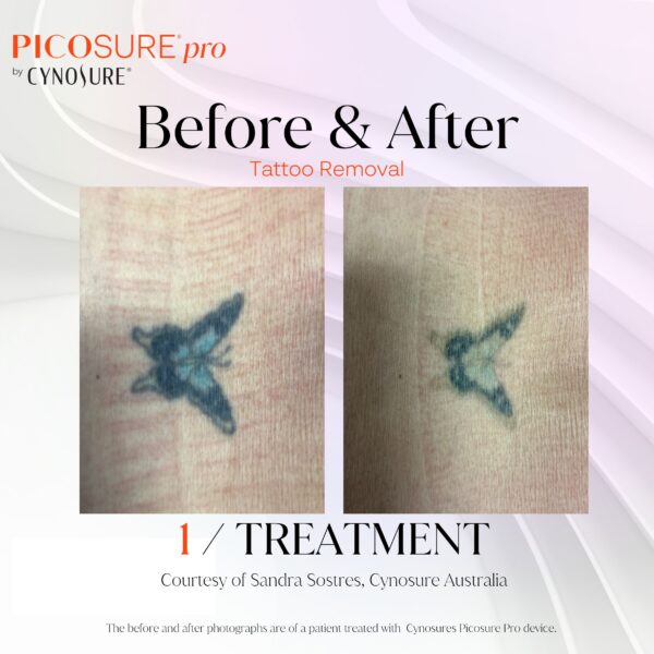 Tattoo Removal with PicoSure®️ Pro Laser