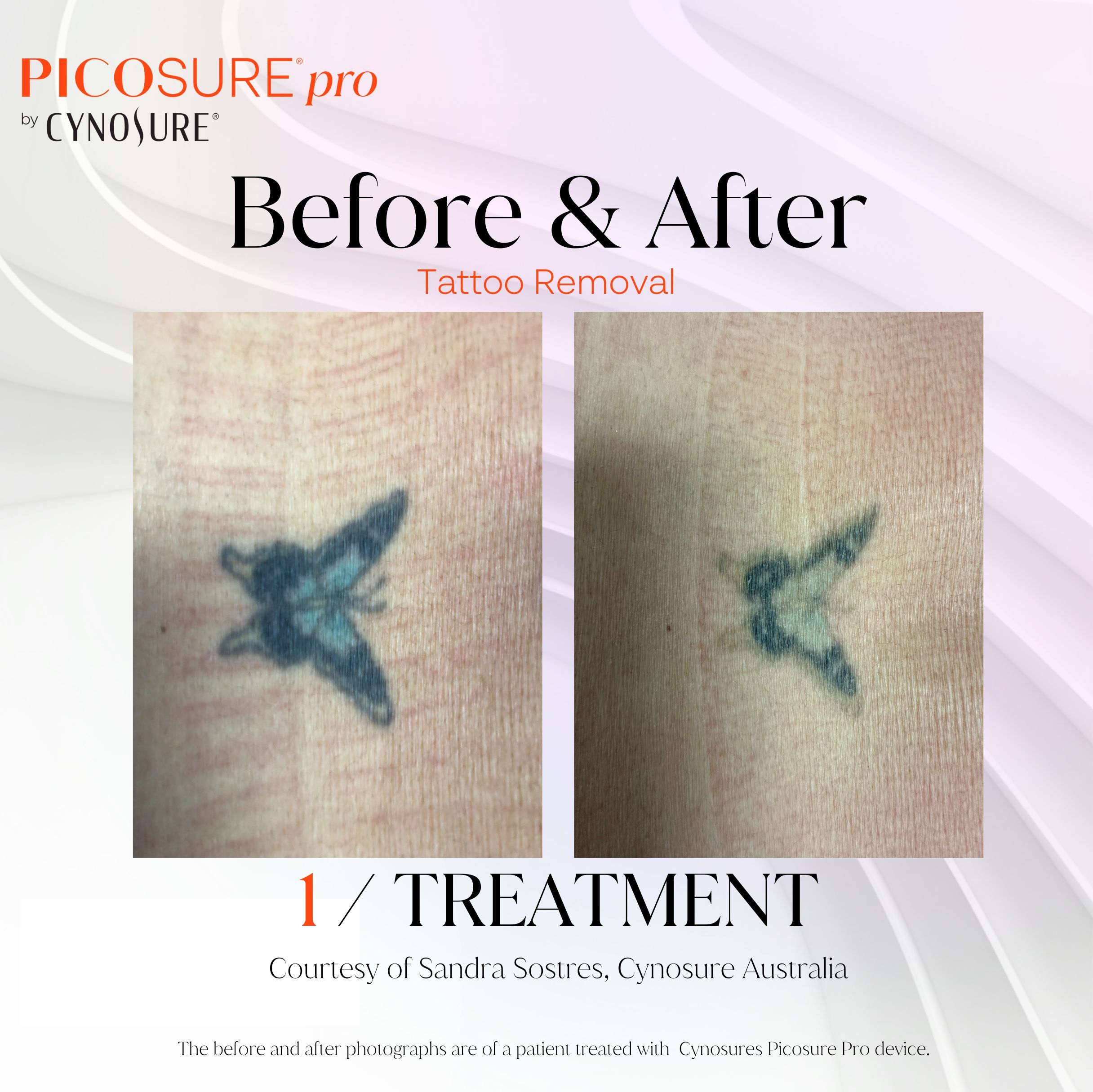 Tattoo Removal with PicoSure®️ Pro Laser