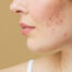 Acne Treatment at LISSE Medical Aesthetics in Gig Harbor & University Place